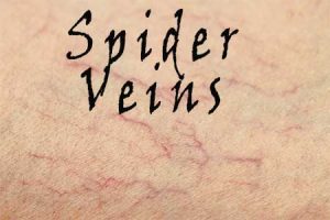 Spider veins
